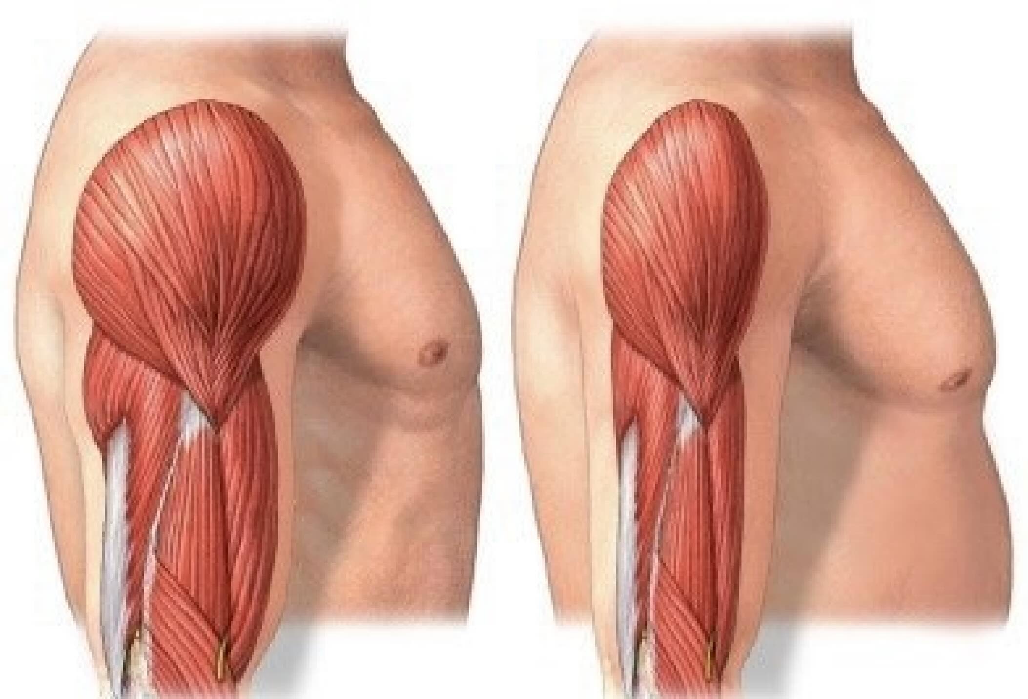 Hipertrofia muscular